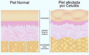 celulitis piel